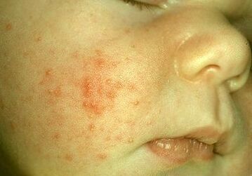parásitos debajo de la piel de un niño